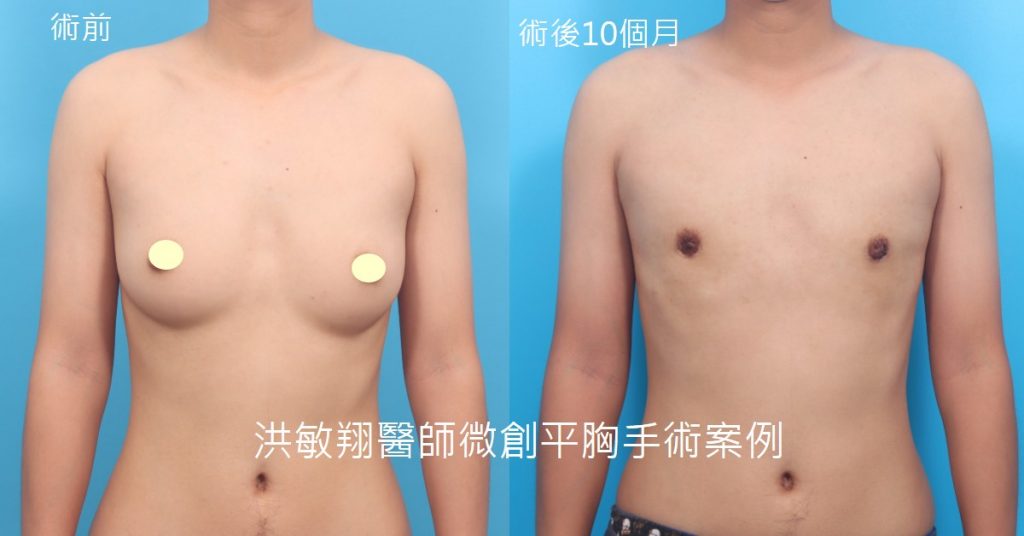 洪敏翔整形外科醫師-平胸手術案例