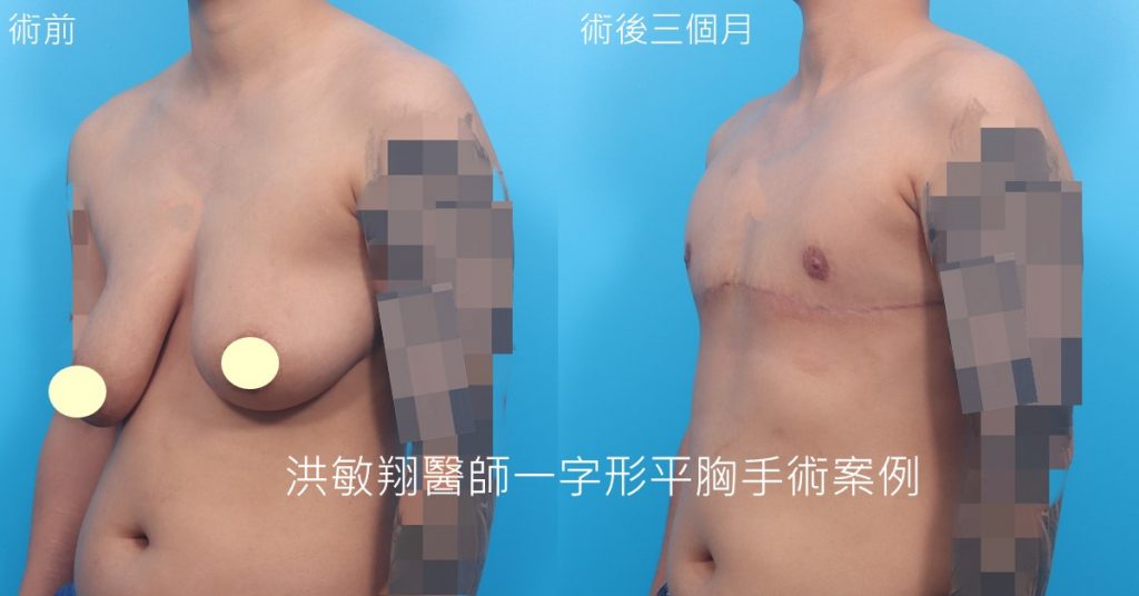洪敏翔整形外科醫師-平胸手術案例