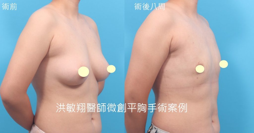 洪敏翔整形外科醫師-平胸手術案例