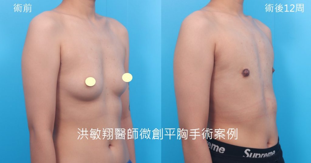 洪敏翔整形外科醫師-平胸手術案例