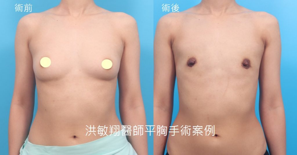 洪敏翔整形外科醫師-平胸手術案例