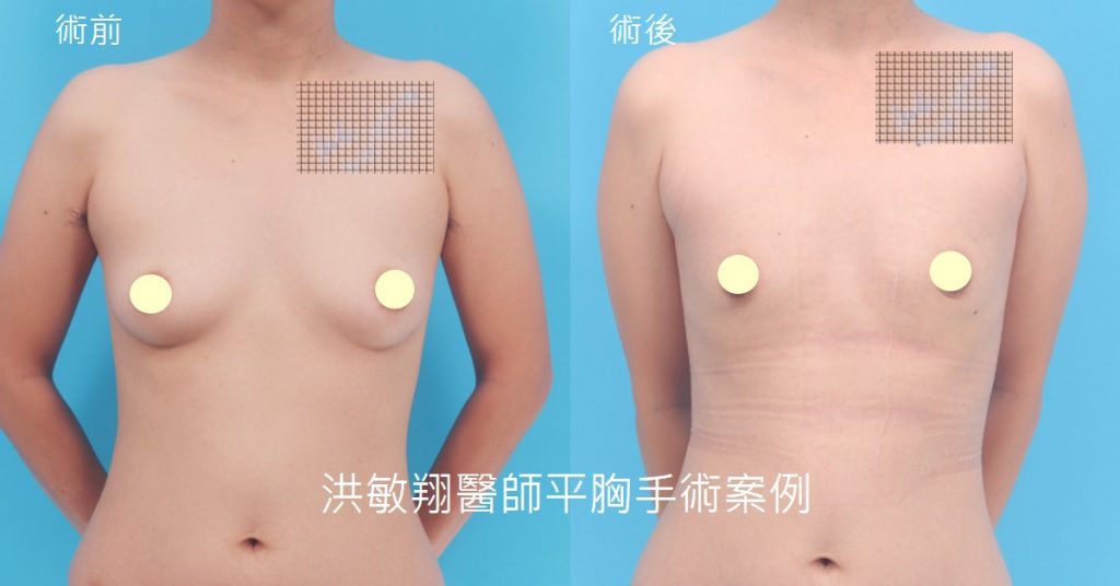 洪敏翔整形外科醫師-平胸手術案例