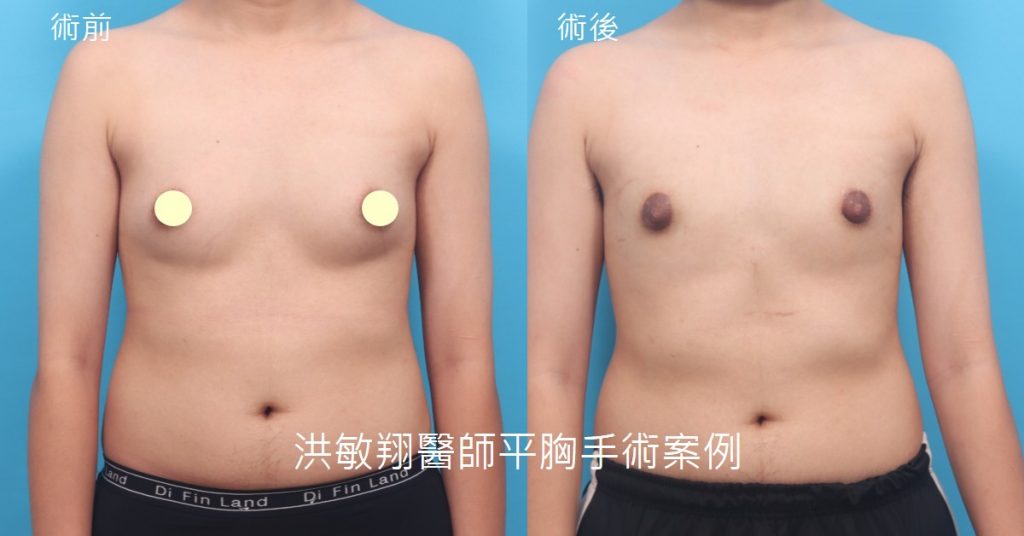 洪敏翔整形外科醫師-平胸手術案例