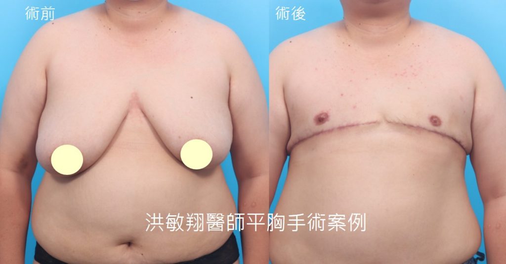 洪敏翔整形外科醫師-平胸手術案例
