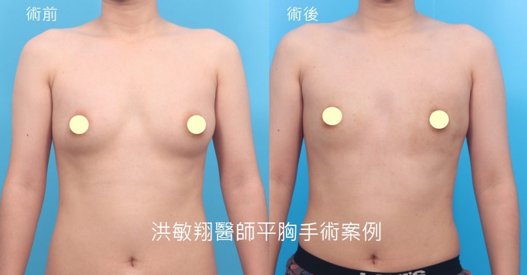 洪敏翔整形外科醫師-平胸手術案例