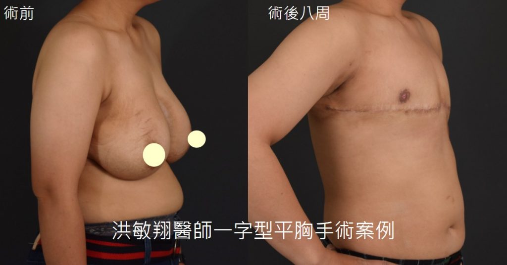 洪敏翔整形外科醫師-平胸手術案例