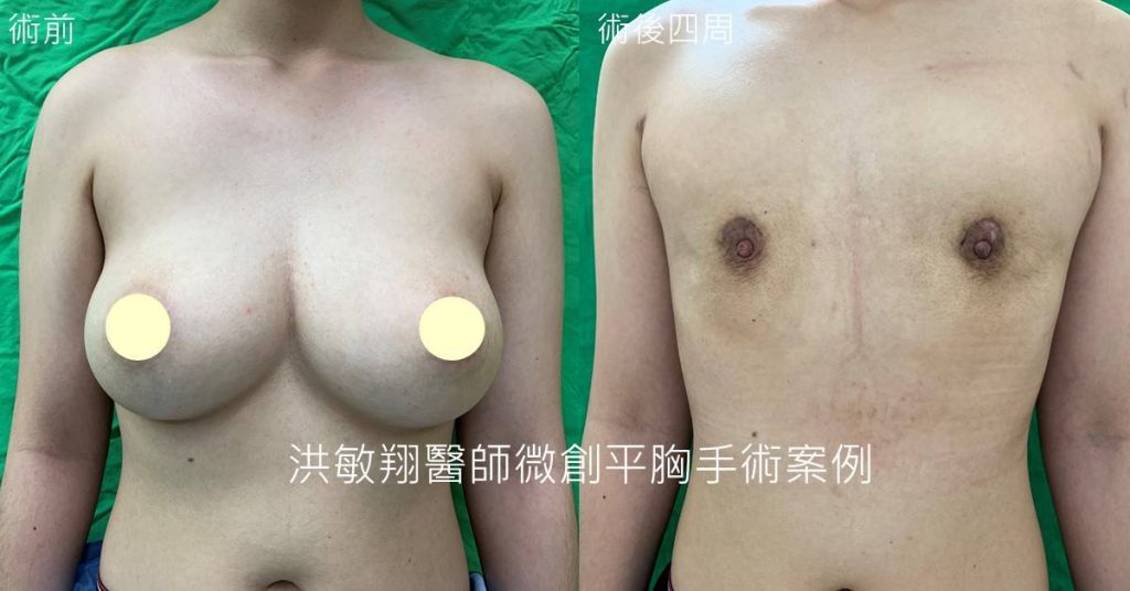 洪敏翔整形外科醫師-平胸手術案例
