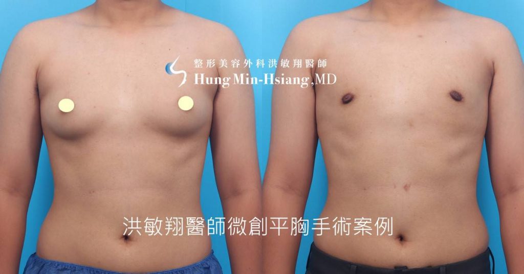 洪敏翔整形外科醫師-平胸手術案例