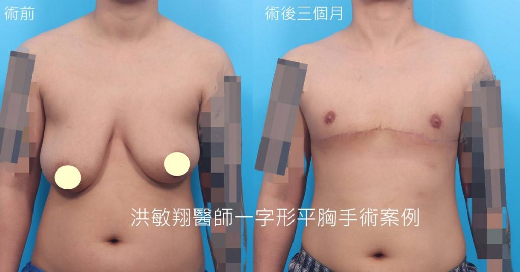 洪敏翔整形外科醫師-平胸手術案例