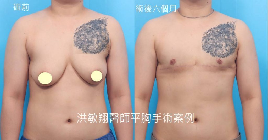 洪敏翔整形外科醫師-平胸手術案例