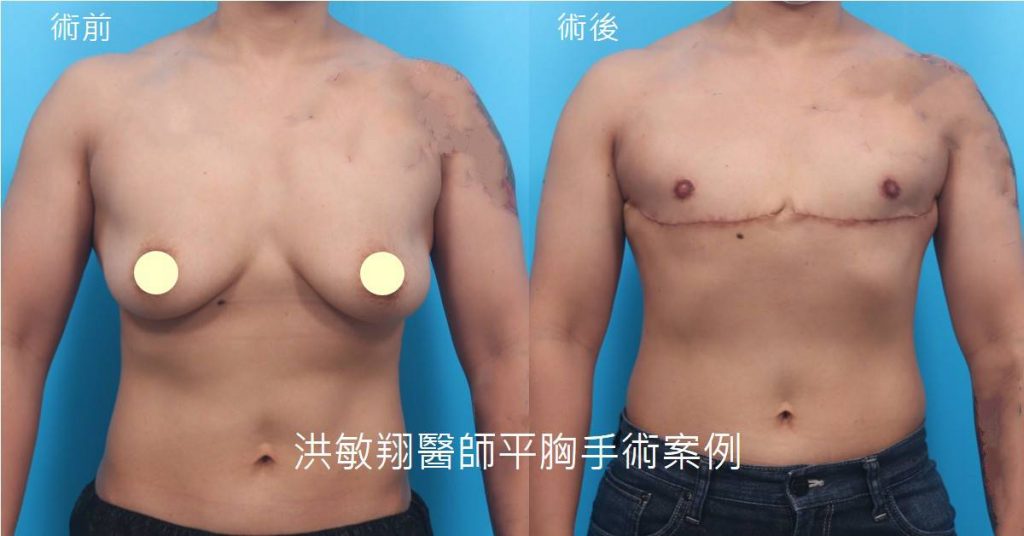 洪敏翔整形外科醫師-平胸手術案例